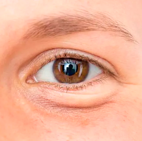 Antes da Blefaroplástia